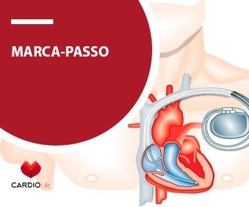 Marca Passo
