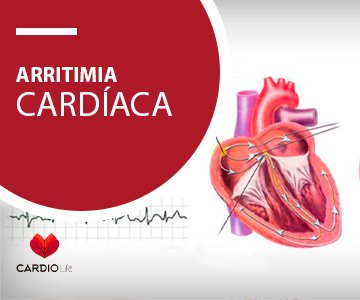 ARRITMIA CARDÍACA