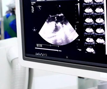 ECOCARDIOGRAMA